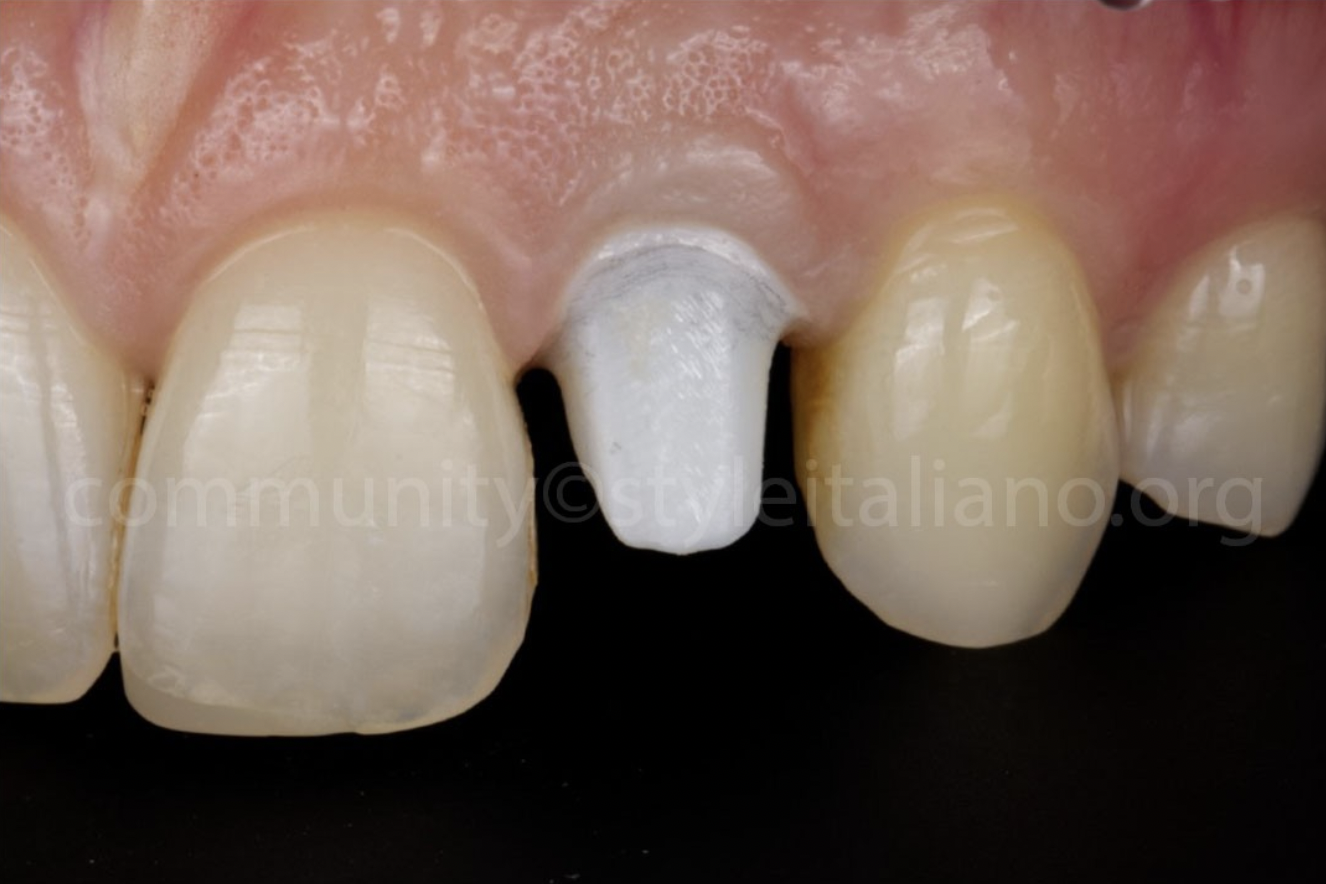 Điều Trị Lại Một Mão Răng Trên Implant: Tối ưu hoá kết quả bằng phần mềm OptiShade